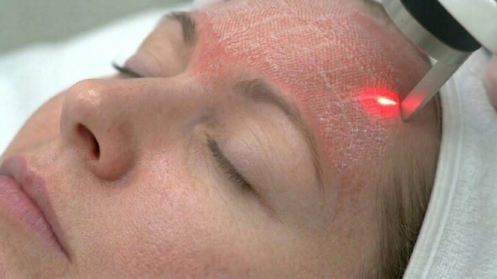 CO2 Laser Resurfacing